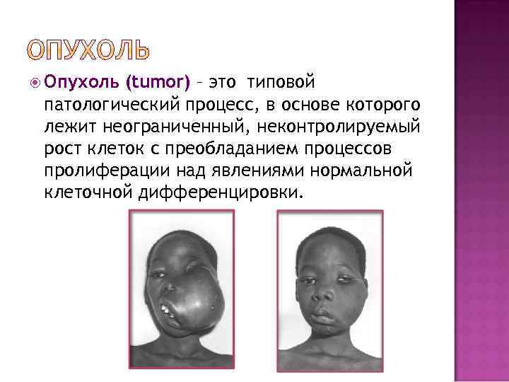  Опухоль (tumor) – это типовой патологический процесс, в основе которого лежит неограниченный, неконтролируемый