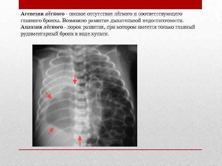 Врожденные пороки развития дыхательной системы презентация