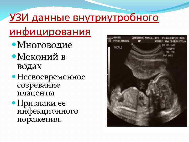 УЗИ данные внутриутробного инфицирования Многоводие Меконий в водах Несвоевременное созревание плаценты Признаки ее инфекционного