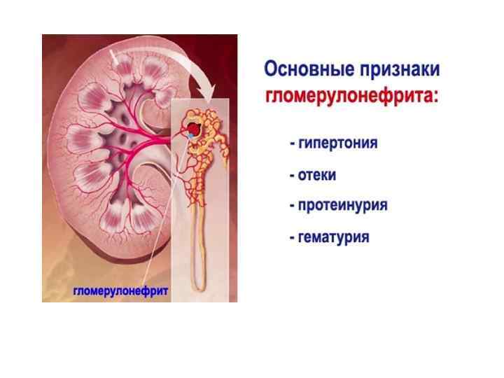 Гломерулонефрит у детей картинки