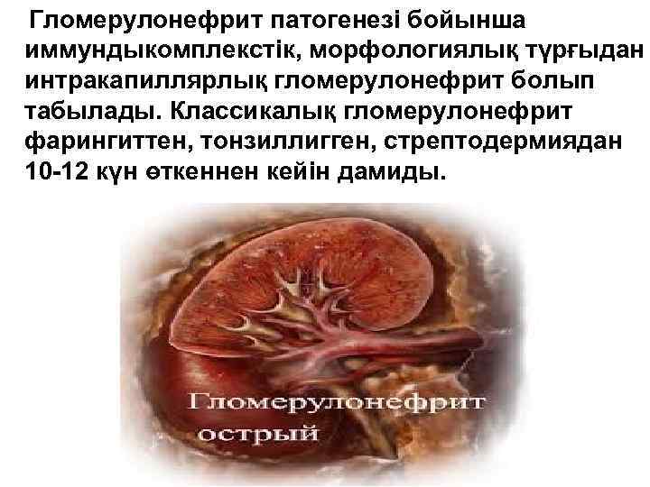 Гломерулонефрит патогенезі бойынша иммундыкомплекстік, морфологиялық түрғыдан интракапиллярлық гломерулонефрит болып табылады. Классикалық гломерулонефрит фарингиттен, тонзиллигген,