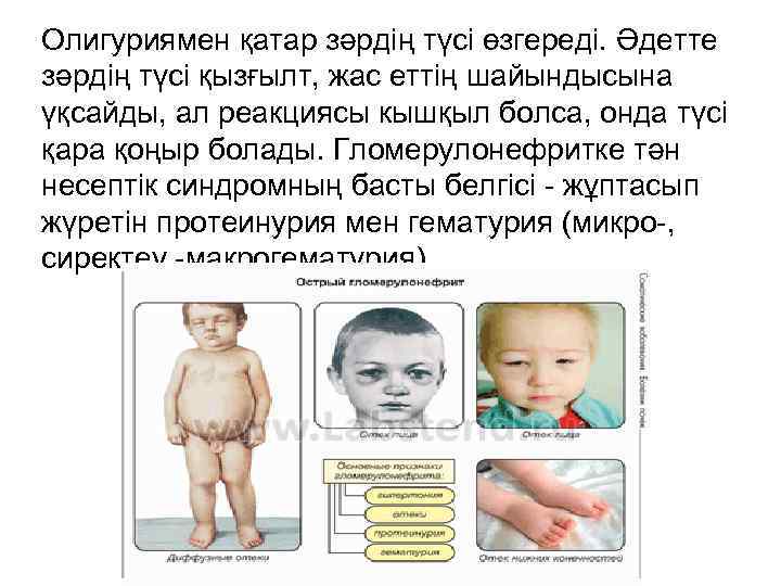 Олигуриямен қатар зәрдің түсі өзгереді. Әдетте зәрдің түсі қызғылт, жас еттің шайындысына үқсайды, ал