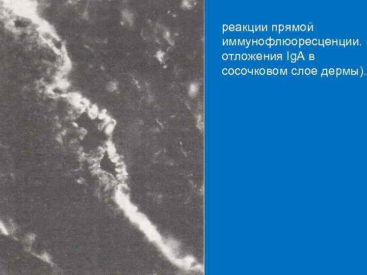 реакции прямой иммунофлюоресценции. отложения Ig. A в сосочковом слое дермы). 