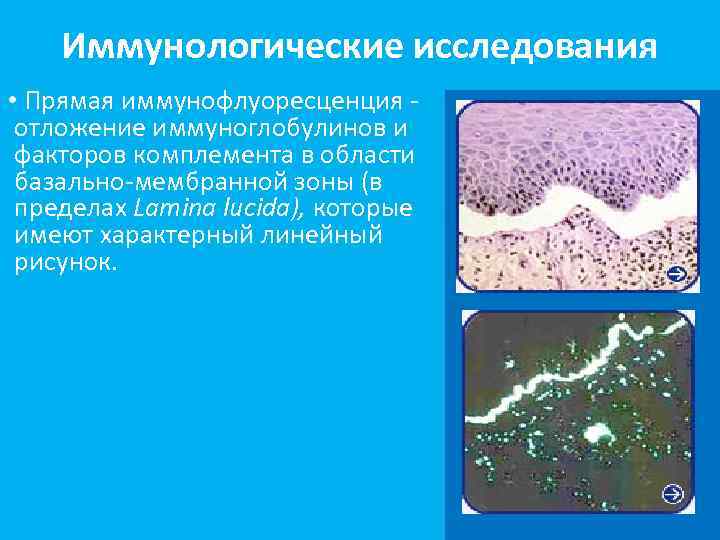 Иммунологические исследования • Прямая иммунофлуоресценция отложение иммуноглобулинов и факторов комплемента в области базально-мембранной зоны