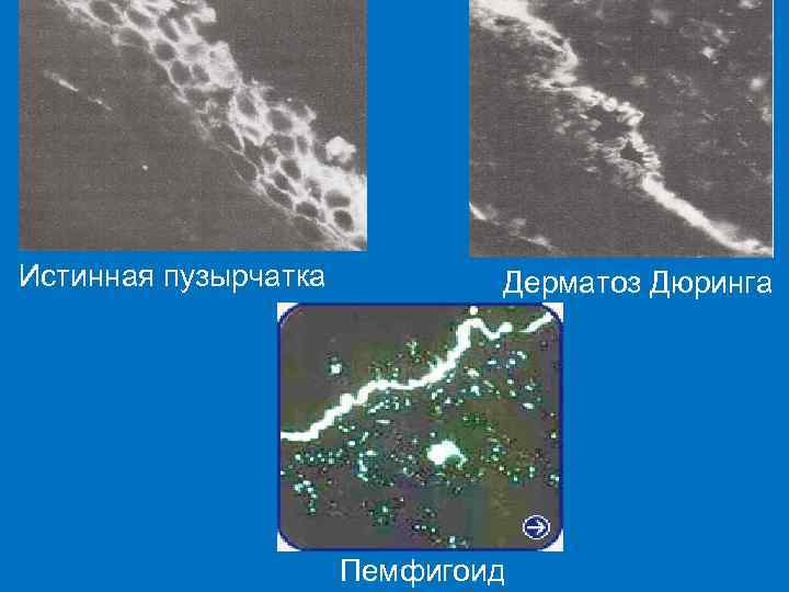 Истинная пузырчатка Дерматоз Дюринга Пемфигоид 