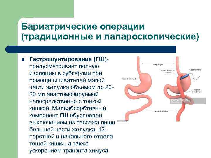 Бариатрические операции (традиционные и лапароскопические) l Гастрошунтирование (ГШ)- предусматривает полную изоляцию в субкардии при