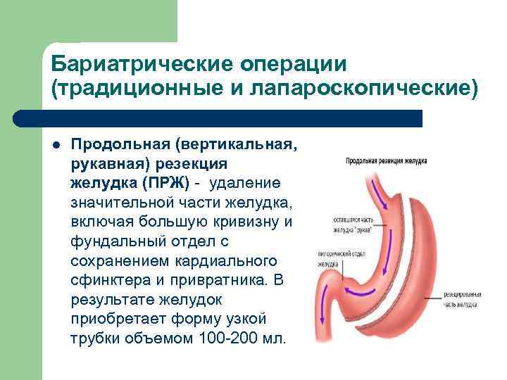 Продольная резекция желудка фото