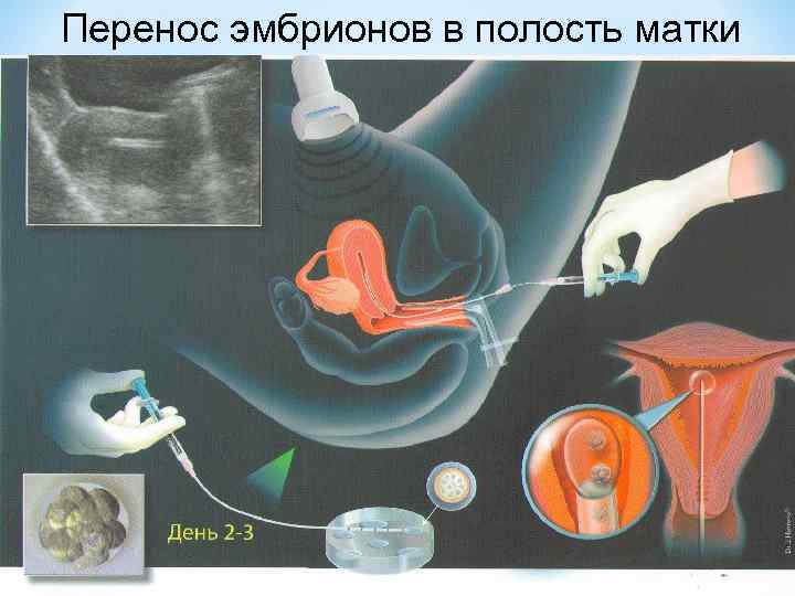 Перенос эмбрионов в полость матки 