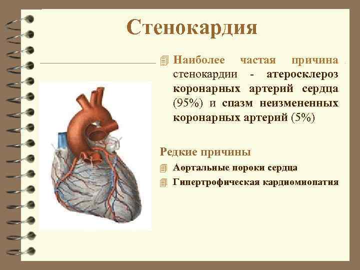 Стенокардия 4 Наиболее частая причина стенокардии - атеросклероз коронарных артерий сердца (95%) и спазм