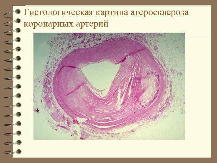 Гистологическая картина атеросклероза коронарных артерий 
