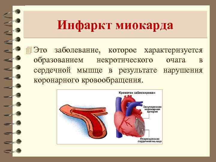 Инфаркт миокарда 4 Это заболевание, которое характеризуется образованием некротического очага в сердечной мышце в