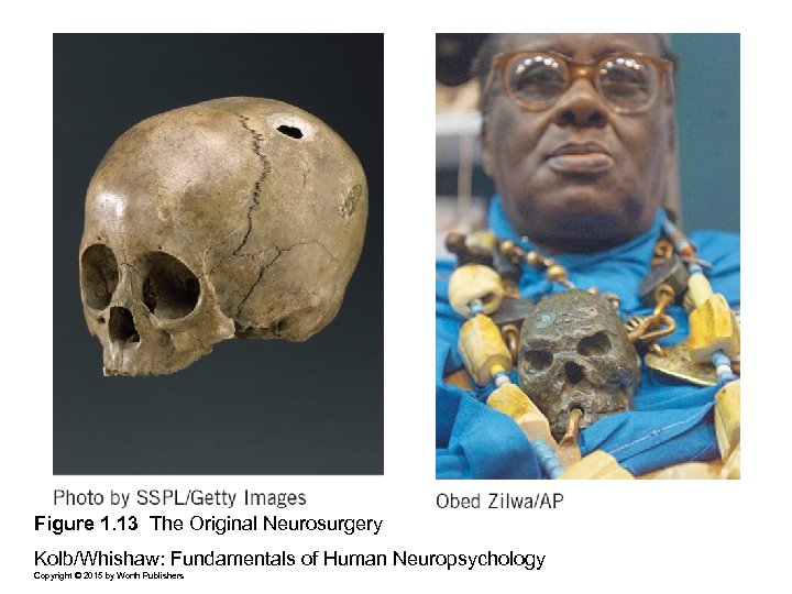 Figure 1. 13 The Original Neurosurgery Kolb/Whishaw: Fundamentals of Human Neuropsychology Copyright © 2015