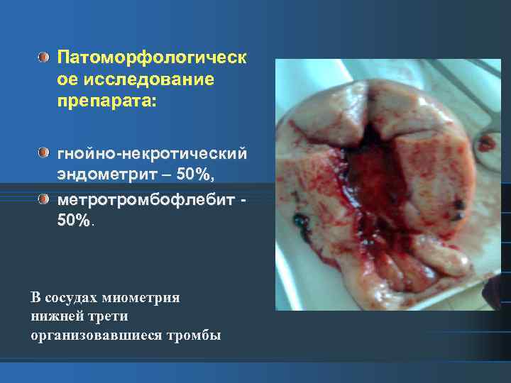 Патоморфологическ ое исследование препарата: гнойно-некротический эндометрит – 50%, метротромбофлебит 50%. В сосудах миометрия нижней
