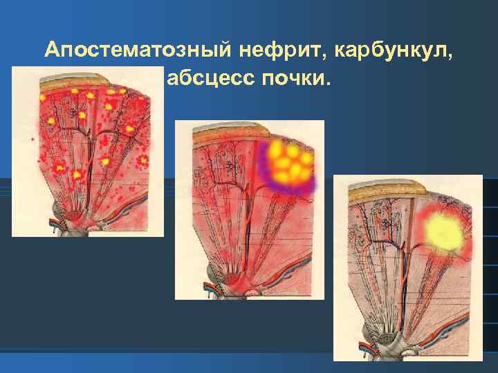 Апостематозный нефрит, карбункул, абсцесс почки. 