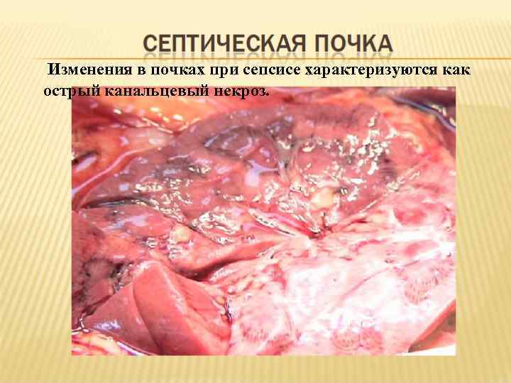  Изменения в почках при сепсисе характеризуются как острый канальцевый некроз. 