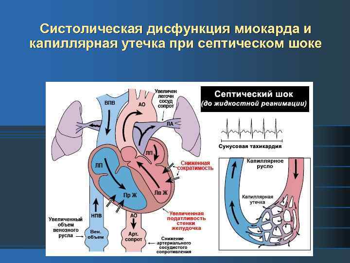 Систолическая дисфункция миокарда и капиллярная утечка при септическом шоке 