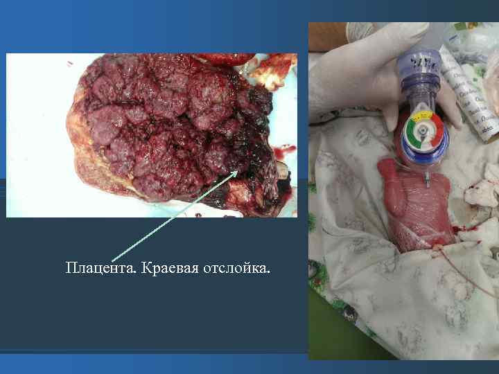Плацента. Краевая отслойка. 