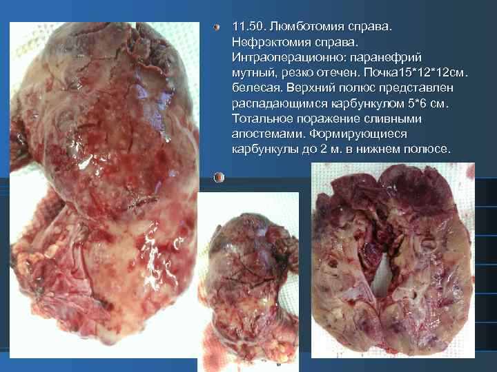 11. 50. Люмботомия справа. Нефрэктомия справа. Интраоперационно: паранефрий мутный, резко отечен. Почка 15*12*12 см.