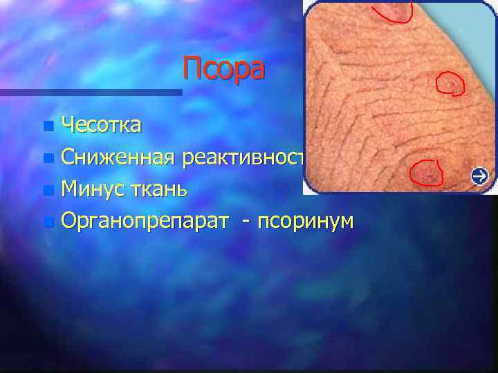 Псора Чесотка n Сниженная реактивность n Минус ткань n Органопрепарат - псоринум n 