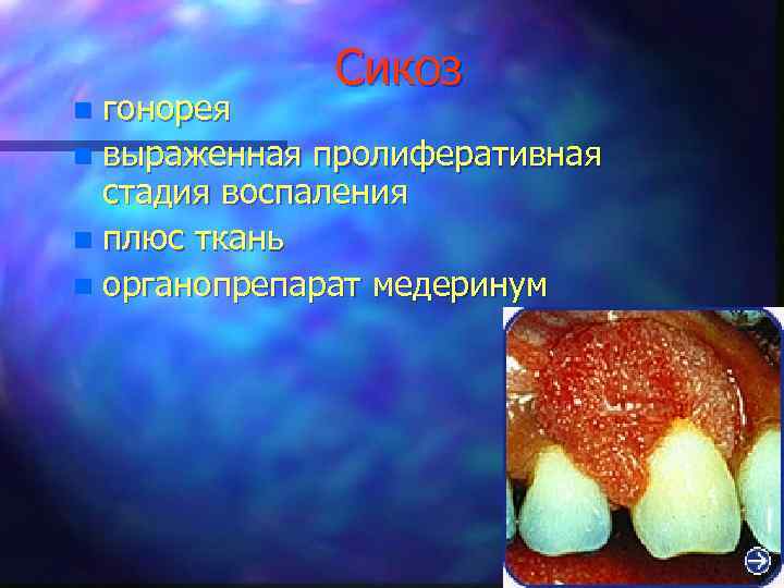 Сикоз гонорея n выраженная пролиферативная стадия воспаления n плюс ткань n органопрепарат медеринум n