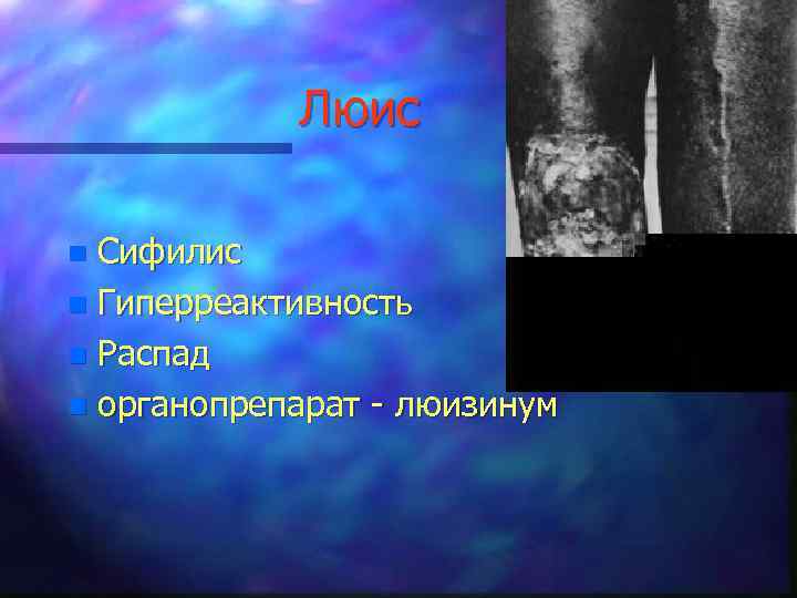 Люис Сифилис n Гиперреактивность n Распад n органопрепарат - люизинум n 
