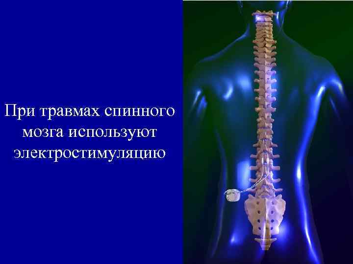 При травмах спинного мозга используют электростимуляцию 