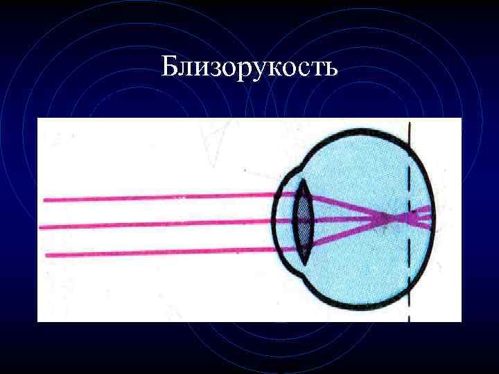 Близорукость 