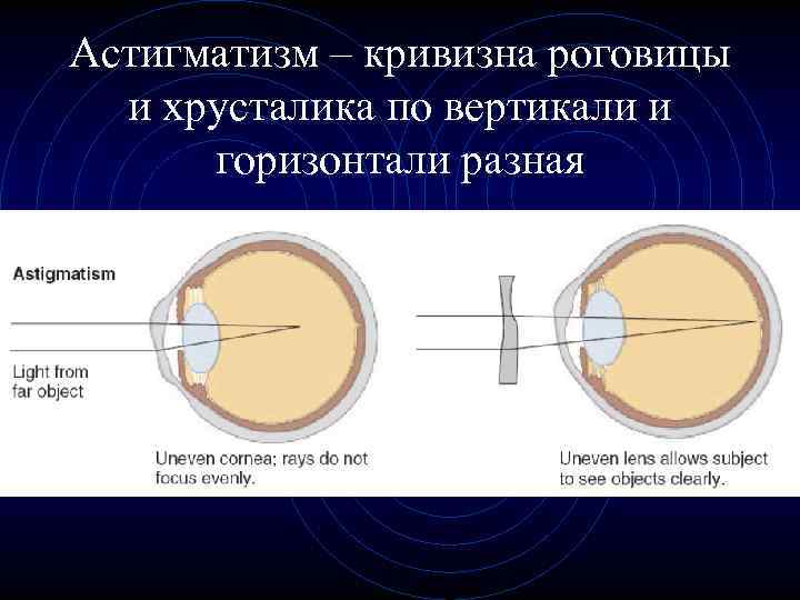 Астигматизм – кривизна роговицы и хрусталика по вертикали и горизонтали разная 