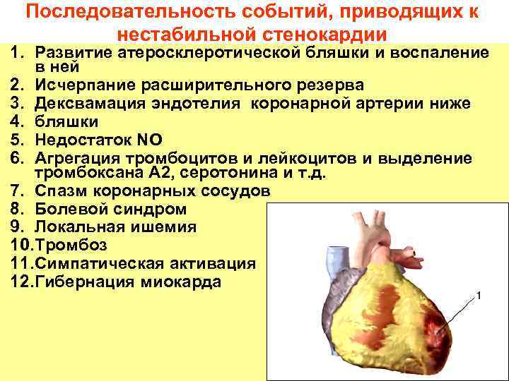 Последовательность событий, приводящих к нестабильной стенокардии 1. Развитие атеросклеротической бляшки и воспаление в ней