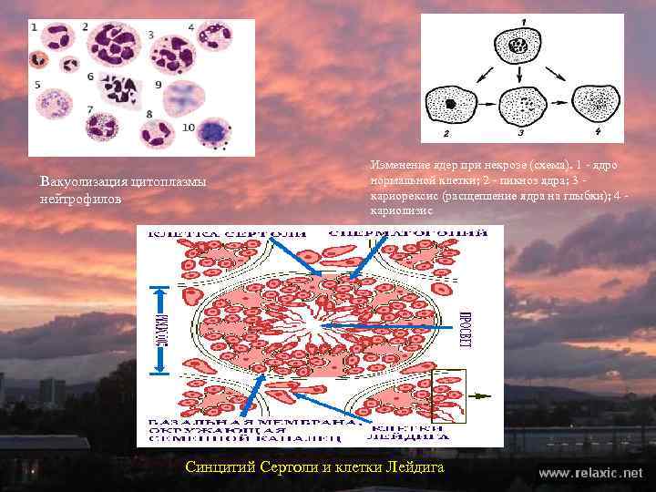 Вакуолизация цитоплазмы нейтрофилов Изменение ядер при некрозе (схема). 1 ядро нормальной клетки; 2 пикноз