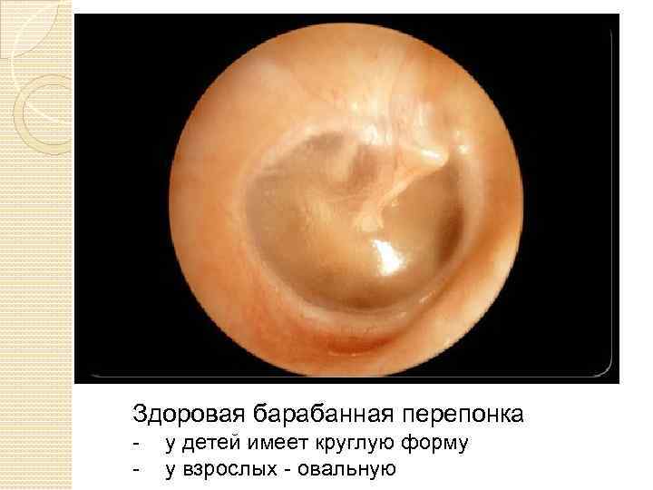 Здоровая барабанная перепонка - у детей имеет круглую форму у взрослых - овальную 
