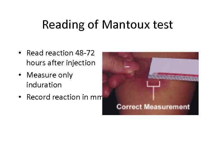 Reading of Mantoux test • Read reaction 48 -72 hours after injection • Measure