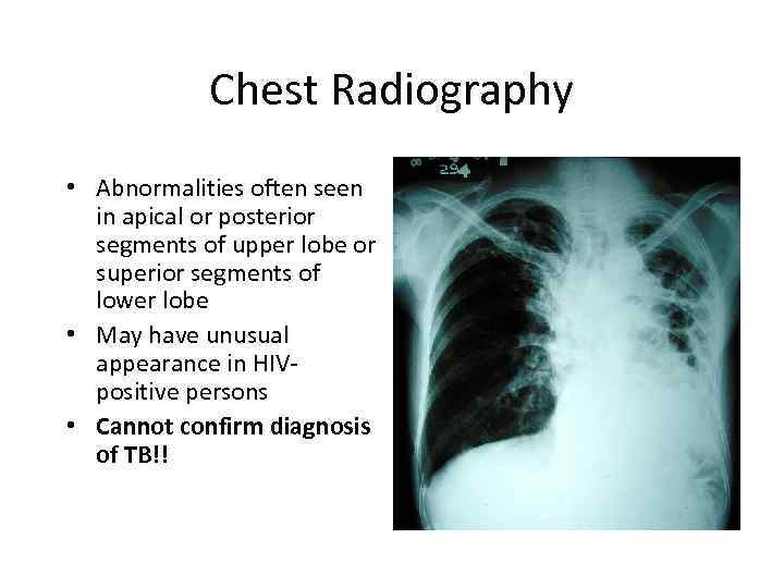 Chest Radiography • Abnormalities often seen in apical or posterior segments of upper lobe