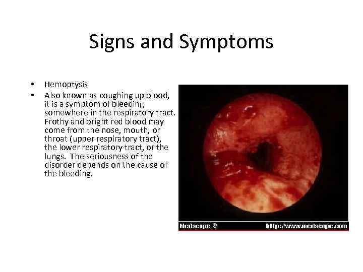 Signs and Symptoms • • Hemoptysis Also known as coughing up blood, it is