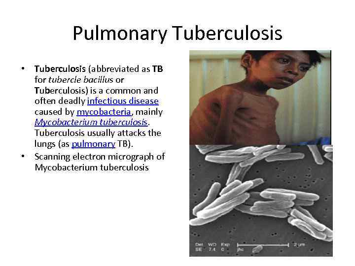 Pulmonary Tuberculosis • Tuberculosis (abbreviated as TB for tubercle bacillus or Tuberculosis) is a