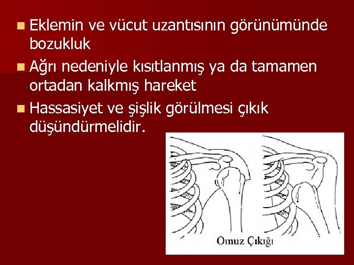 n Eklemin ve vücut uzantısının görünümünde bozukluk n Ağrı nedeniyle kısıtlanmış ya da tamamen