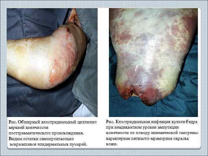 Рис. Обширный клостридиальный целлюлит верхней конечности посттравматического происхождения. Видны остатки самопроизвольно вскрывшихся эпидермальных пузырей.