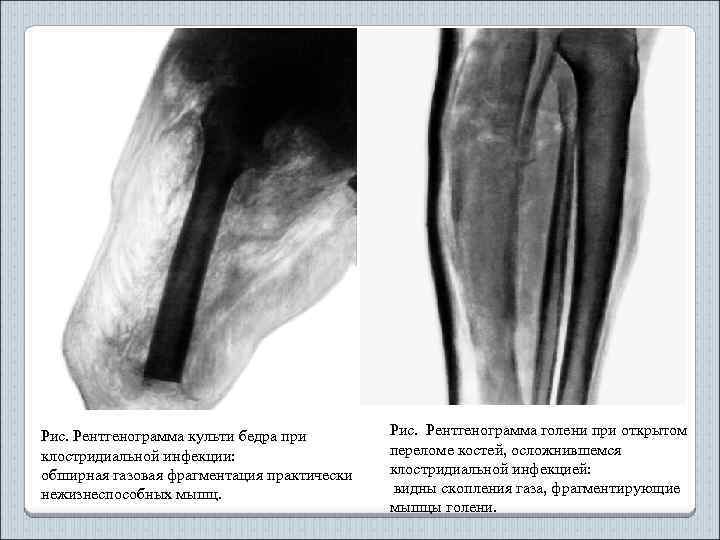 Рис. Рентгенограмма культи бедра при клостридиальной инфекции: обширная газовая фрагментация практически нежизнеспособных мышц. Рис.
