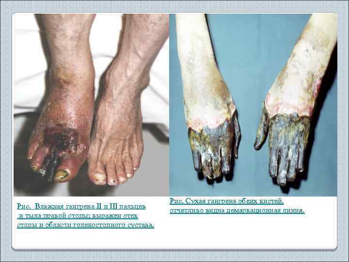 Рис. Влажная гангрена II и III пальцев и тыла правой стопы; выражен отек стопы