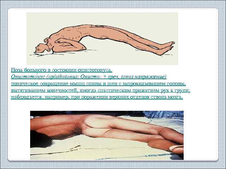 Поза больного в состоянии опистотонуса. Опистото нус (opisthotonus; Описто- + греч, tonos напряжение) тоническое