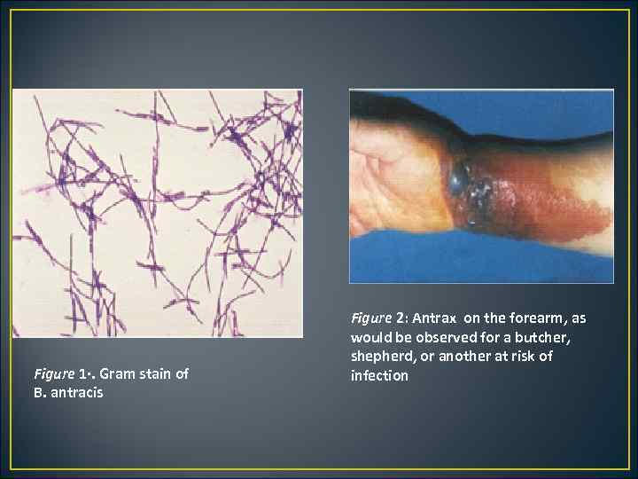 Figure 1·. Gram stain of B. antracis Figure 2: Antrax on the forearm, as