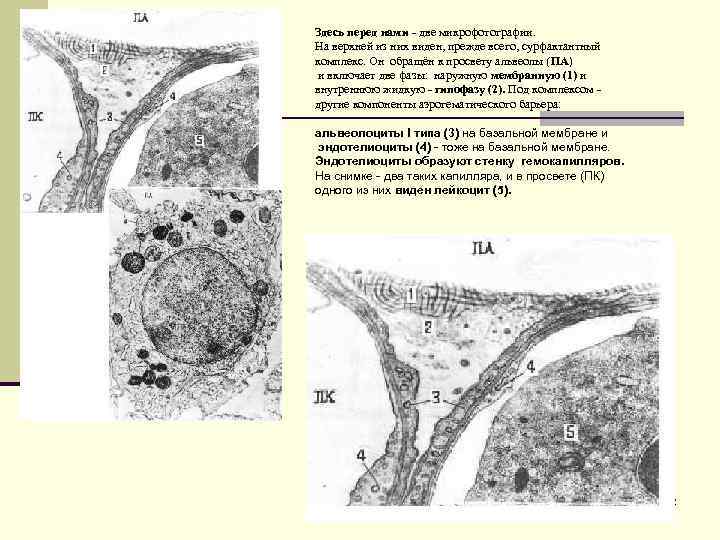 Здесь перед нами - две микрофотографии. На верхней из них виден, прежде всего, сурфактантный