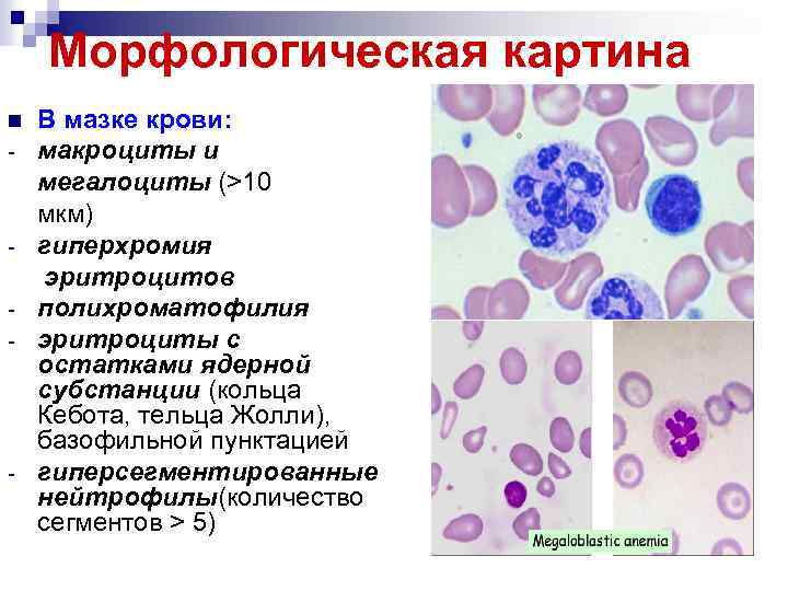 Морфологическая картина n - - - В мазке крови: макроциты и мегалоциты (>10 мкм)