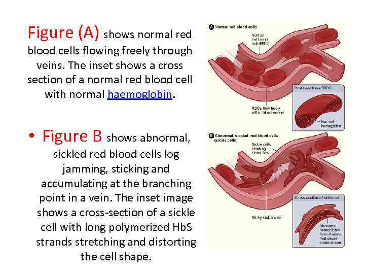 Figure (A) shows normal red blood cells flowing freely through veins. The inset shows