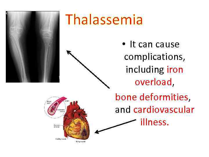 Thalassemia • It can cause complications, including iron overload, bone deformities, and cardiovascular illness.