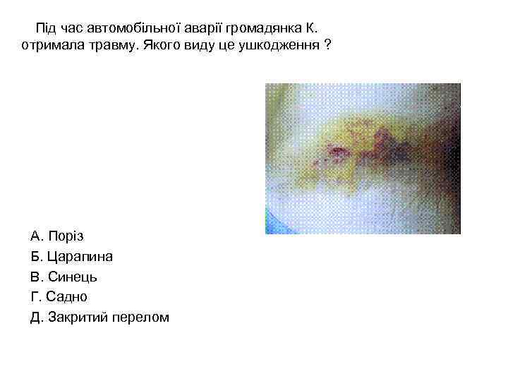 Під час автомобільної аварії громадянка К. отримала травму. Якого виду це ушкодження ? А.