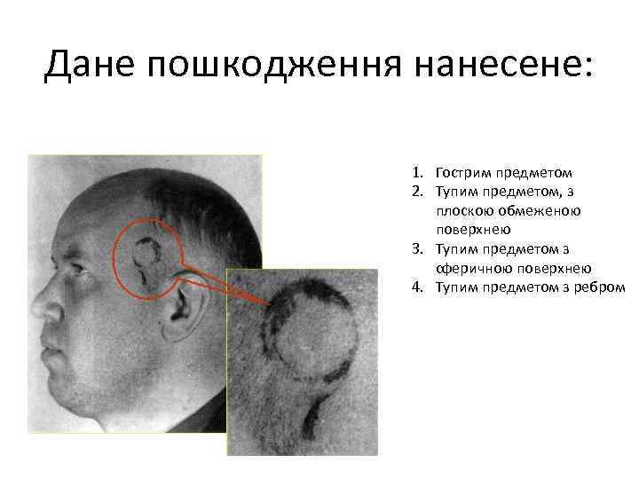 Дане пошкодження нанесене: 1. Гострим предметом 2. Тупим предметом, з плоскою обмеженою поверхнею 3.