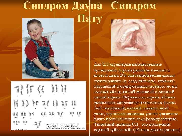 Синдром Дауна Синдром Пату Для СП характерны множественные врожденные пороки развития головного мозга и
