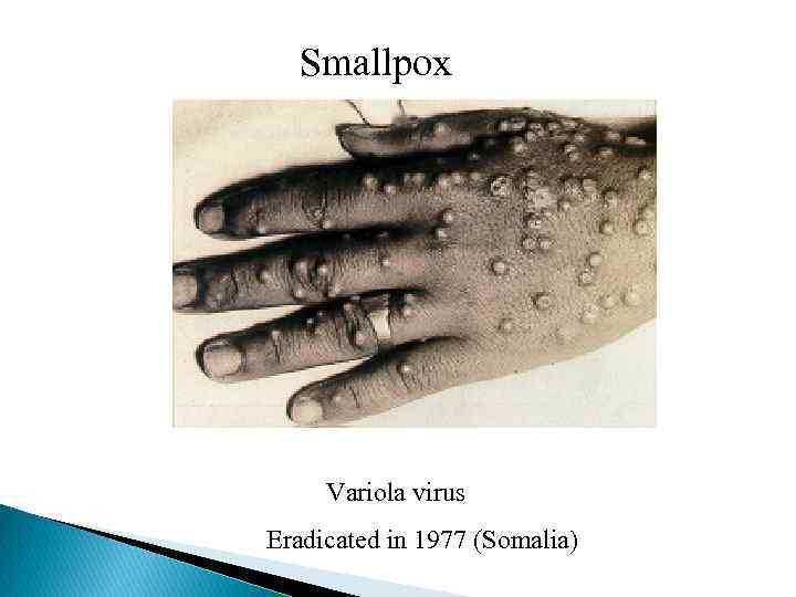 Smallpox Variola virus Eradicated in 1977 (Somalia) 