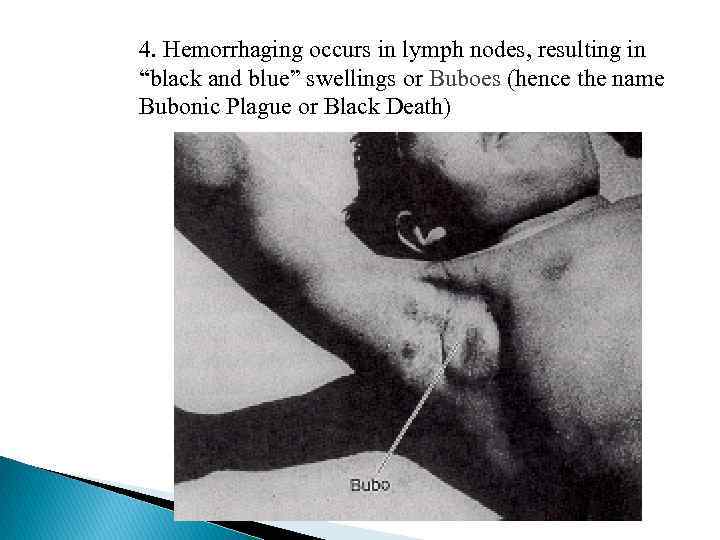 4. Hemorrhaging occurs in lymph nodes, resulting in “black and blue” swellings or Buboes